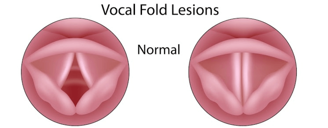 attachment-what-are-the-symptons-of-laryngitis-and-how-can-it-be-treated